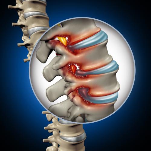 blog spinal stenosis car accident