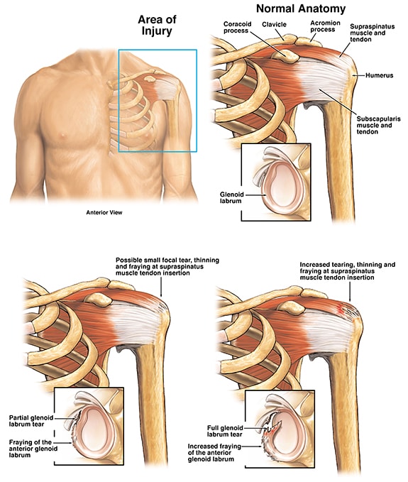 rotator cuff tear car accident settlement min