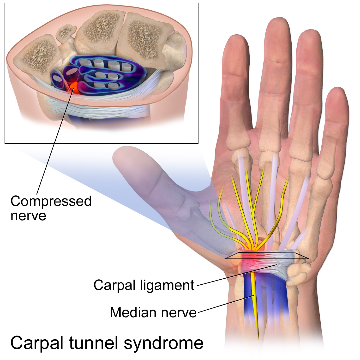 Can a Car Accident Cause Carpal Tunnel Syndrome?